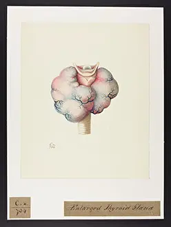 Ucl Library Services Digital Collections: Enlarged Thyroid Gland