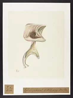 Ucl Library Services Digital Collections: Enlargement of Biliary Ducts