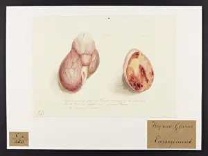 Ucl Library Services Digital Collections: Enlargement of the Thyroid Gland