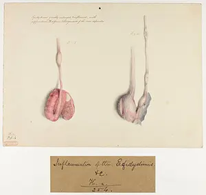 Suppuration: Epidydimis Enlarged and Inflamed with Suppuration