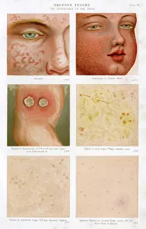 Slight: Eruptive Fevers - Plate 6