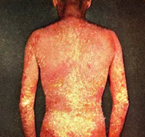Syndrome: Erythroderma