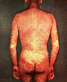 Syndrome: Erythroderma
