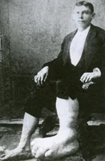 Freak: Eugene Berry, Ohio Big Foot Boy