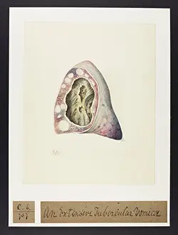 Extensive: An Extensive Tubercular Vomica