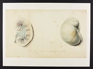 Hopital: External Surface and Section of Granulated Pale Kidney
