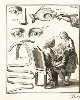 Gland: Eye surgery, 18th century