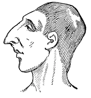 Verbal: Face and head of a cretin, 1902