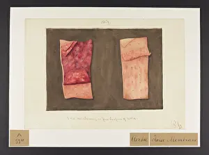 1831: False Membranes on Free Surface of Aorta