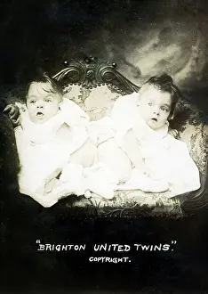 Conjoined: Famous conjoined sisters Daisy and Violet Hilton