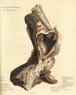 Ulcers: Fatal aneurysmal sac from the broken leg of a man, 1815