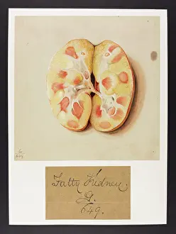 Liver: Fatty Kidneys and Liver