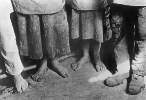 Impoverished: Feet of begging adolescents, 1932