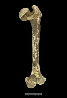 Femur: Femur of Achondroplastic Dwarf