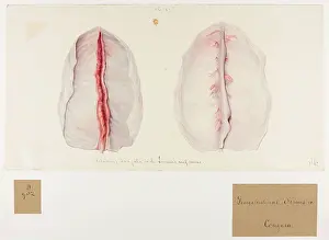Blank: Fibrinous Coagula: Sinuses and Veins