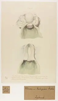 Charita©: Fibrinous Concretion in Ovaria