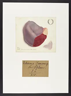 Fibrinous Tumour of the Spleen