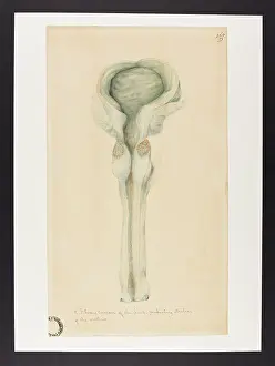 Tumour: Fibrous Tumour of the Bulb Producing Stricture of Urethra
