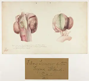 Ucl Library Services Digital Collections: Fibrous Tumour of the Thyroid Gland