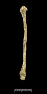 Fibula: Fibula of Achondroplastic Dwarf