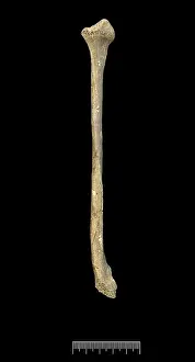 Fibula: Fibula of Achondroplastic Dwarf