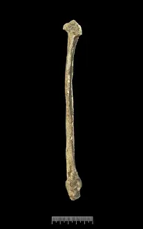 Fibula: Fibula of Achondroplastic Dwarf