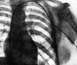 Torso: First cardiac catheterisation experiment, Forssmann