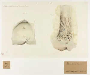 Perforation: Fistula in Ano, Perforation of Rectum and Vagina