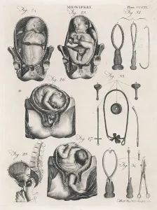 Foetus: FOETUS AND INSTRUMENTS