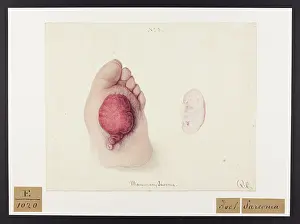 Sarcoma: Foot and Mammory Sarcoma