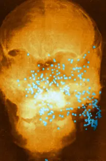 X Ray: Forensic X-Ray of Murder Victim