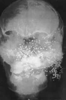 Procedure: Forensic X-Ray of Murder Victim
