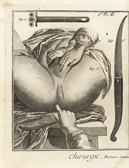 Incision: Foubert's surgical operation to remove a bladder stone: