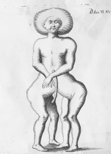 1687: FOUR-LEGGED FOETUS