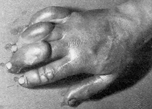 Swollen: Frostbitten hand of Edward Atkinson, Antarctic expedition 19
