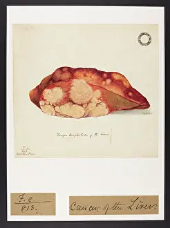 Liver: Fungus Encephalodes of the Liver