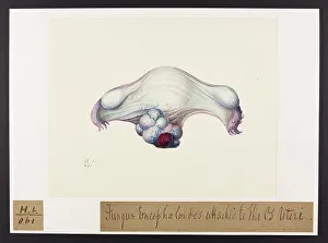 Uterus: Fungus Encephaloides attached to OS Uterus