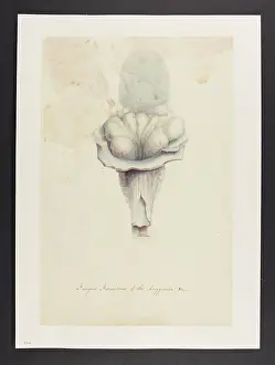 Ucl Library Services Digital Collections: Fungus Haematodes of the Amygdalae