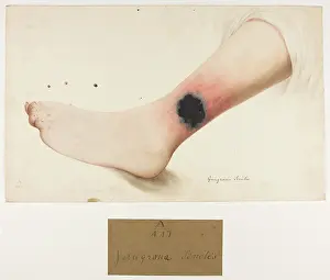 Salpetriere: Gangrena Senilis