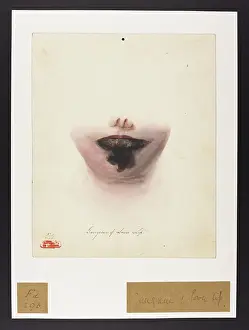 Hopital: Gangrene of the Lower Lip