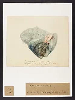 Lung: Gangrene of the Lung