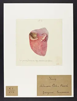 Pneumonia: Gangrene and Pneumonia