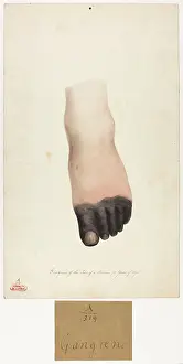 Gangrene of the Toes