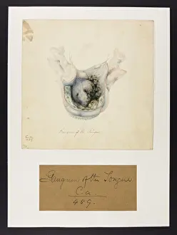 Ucl Library Services Digital Collections: Gangrene of the Tongue