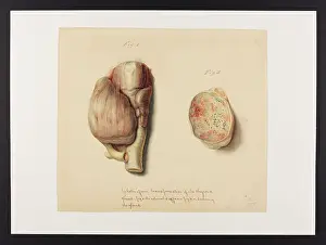 1831: Gelatiform Transformation of the Thyroid Gland