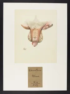 Blank: Glans Penis Ulcers