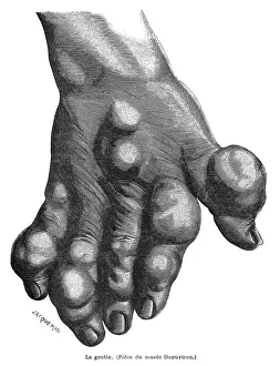 Symptom: GOUT SYMPTOMS ON HAND