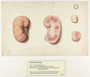 Kidney: Granular Kidney