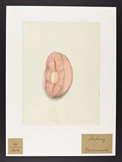 Tumour: Granular Kidney