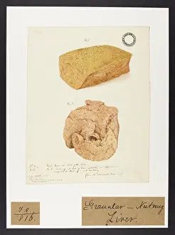 Liver: Granular: Nutmeg Liver
